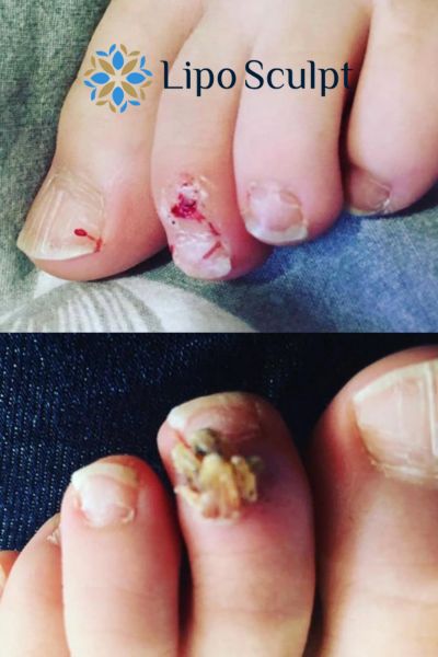 Wart removal customer results from Lipo Sculpt Blandford Forum